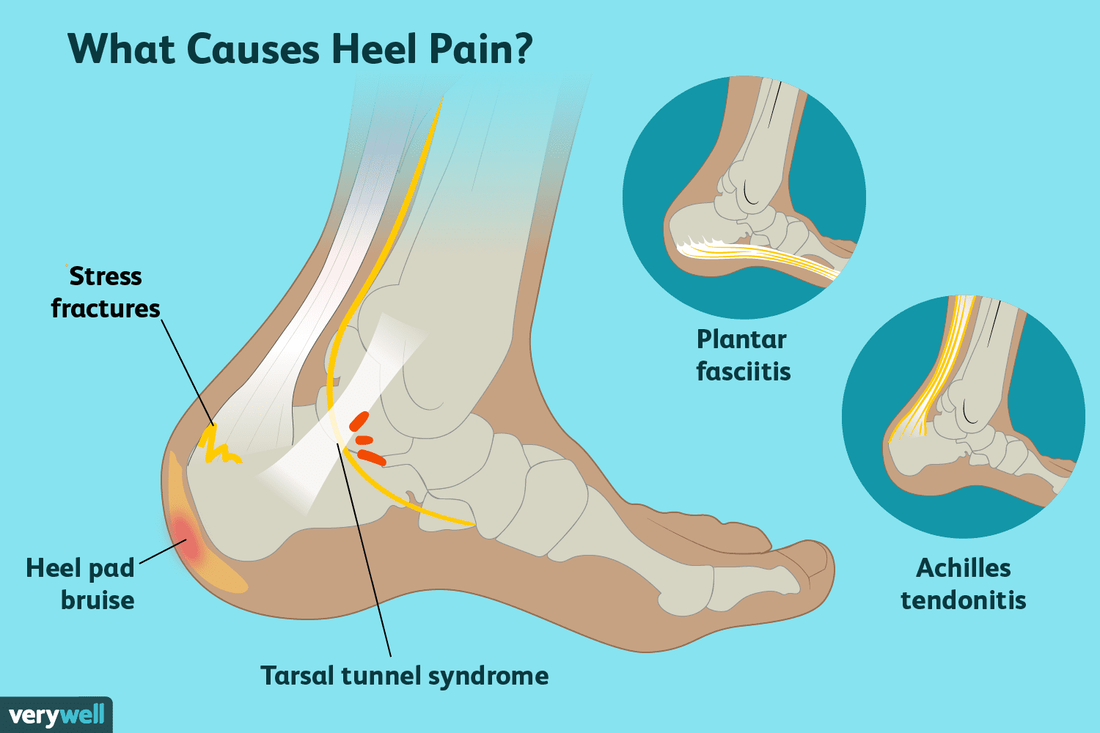 How You Can Treat Plantar Fasciitis at Home | OrthoBethesda